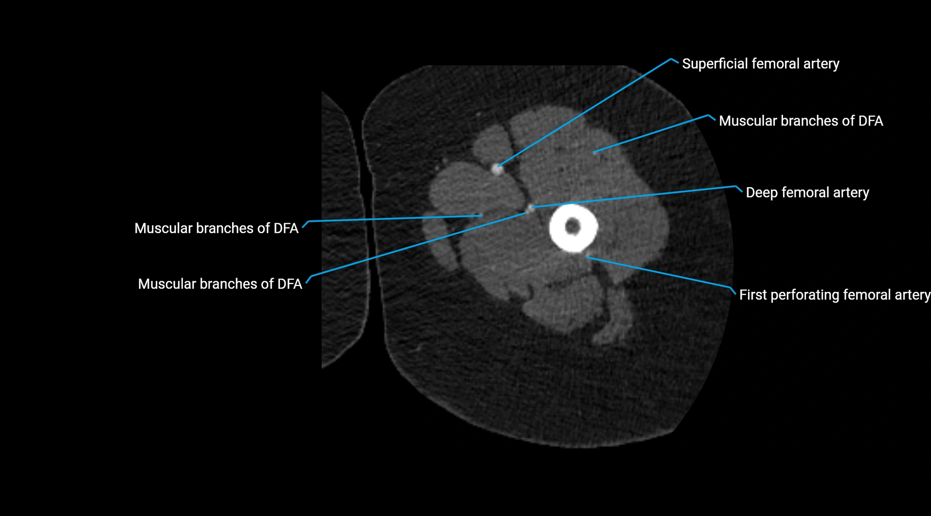 CTA lower limb cross sectional anatomy labelled image _101.webp